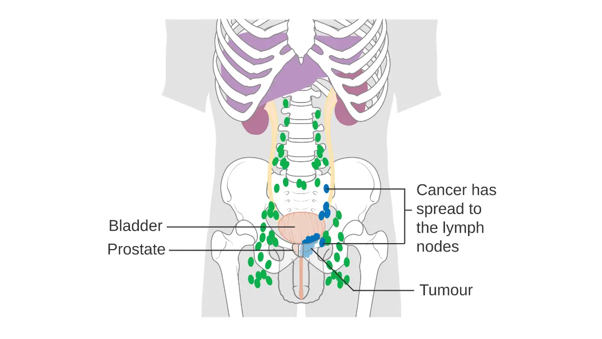 Medical diagram illustrating advanced prostate cancer that has spread to the lymph nodes, showing the critical difference between silent early signs and later-stage metastatic disease symptoms.