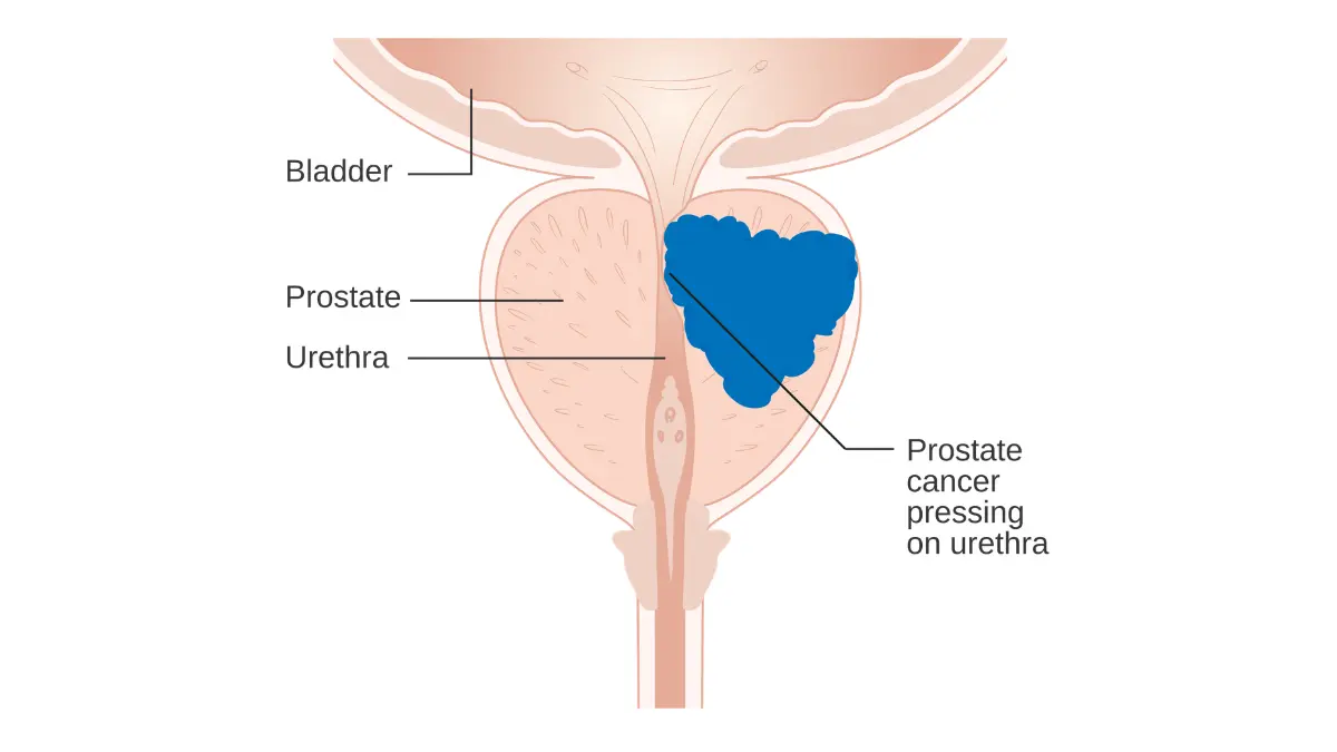 Prostate cancer diagram showing a tumor pressing on the urethra and affecting urine flow inside the prostate region.