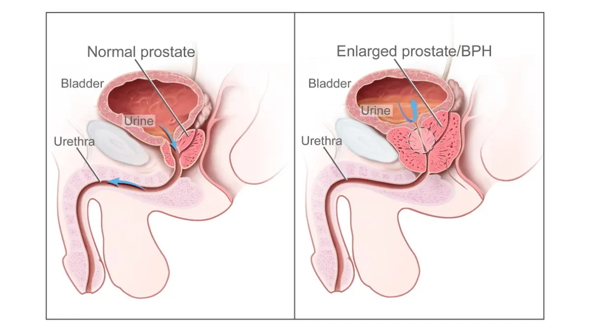 prostate cancer symptoms comparison image showing normal prostate and enlarged prostate affecting urine flow