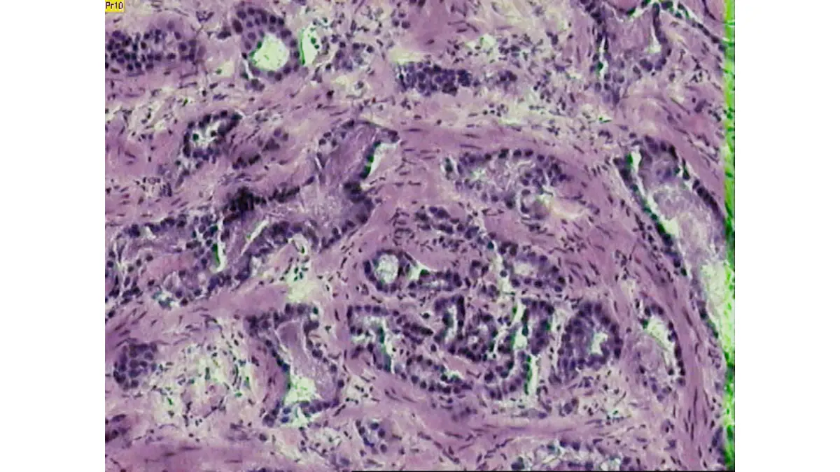 prostate cancer symptoms pathology image showing invasive prostate adenocarcinoma tissue