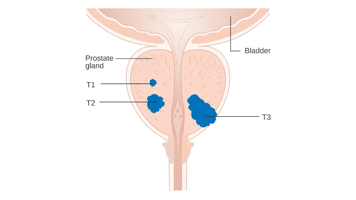 Prostate cancer staging diagram showing T1 to T3 tumor progression within and beyond the prostate gland.