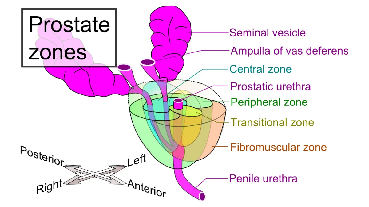 Color-coded 3D diagram of prostate gland zones showing where early signs of prostate cancer typically originate silently in the outer peripheral area before affecting the urethra.