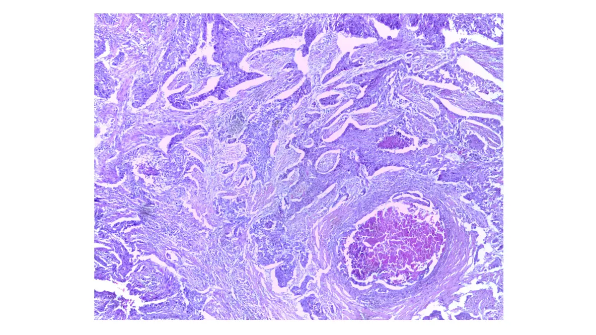 Histopathology microscope slide showing squamous cell carcinoma of the lung at 4x magnification — the NSCLC lung cancer type most directly caused by cigarette smoking