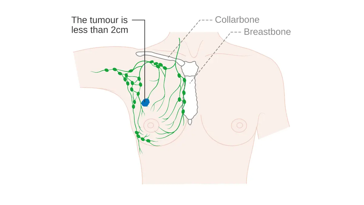 Breast cancer in Black women — Stage 1A breast cancer diagram with early tumor confined to breast tissue and no lymph node involvement.