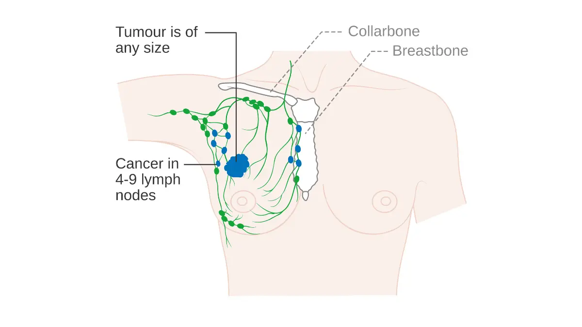 Breast cancer in Black women — Stage 3A breast cancer diagram showing regional lymph node involvement and advanced local tumor progression.