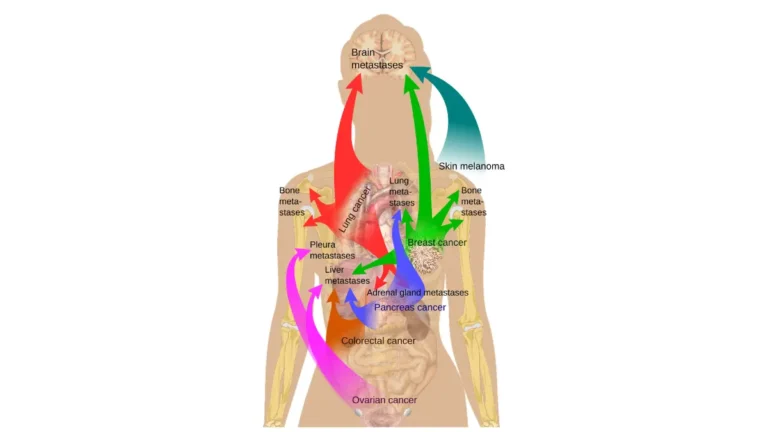 Medical vector diagram showing common metastasis sites for stage 4 breast cancer throughout the human body.