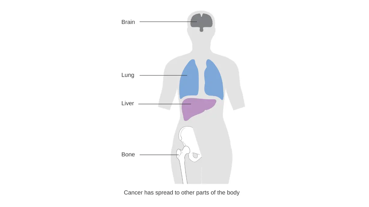 Breast cancer in Black women — Stage 4 metastatic breast cancer diagram showing distant organ spread and advanced disease progression beyond the breast.