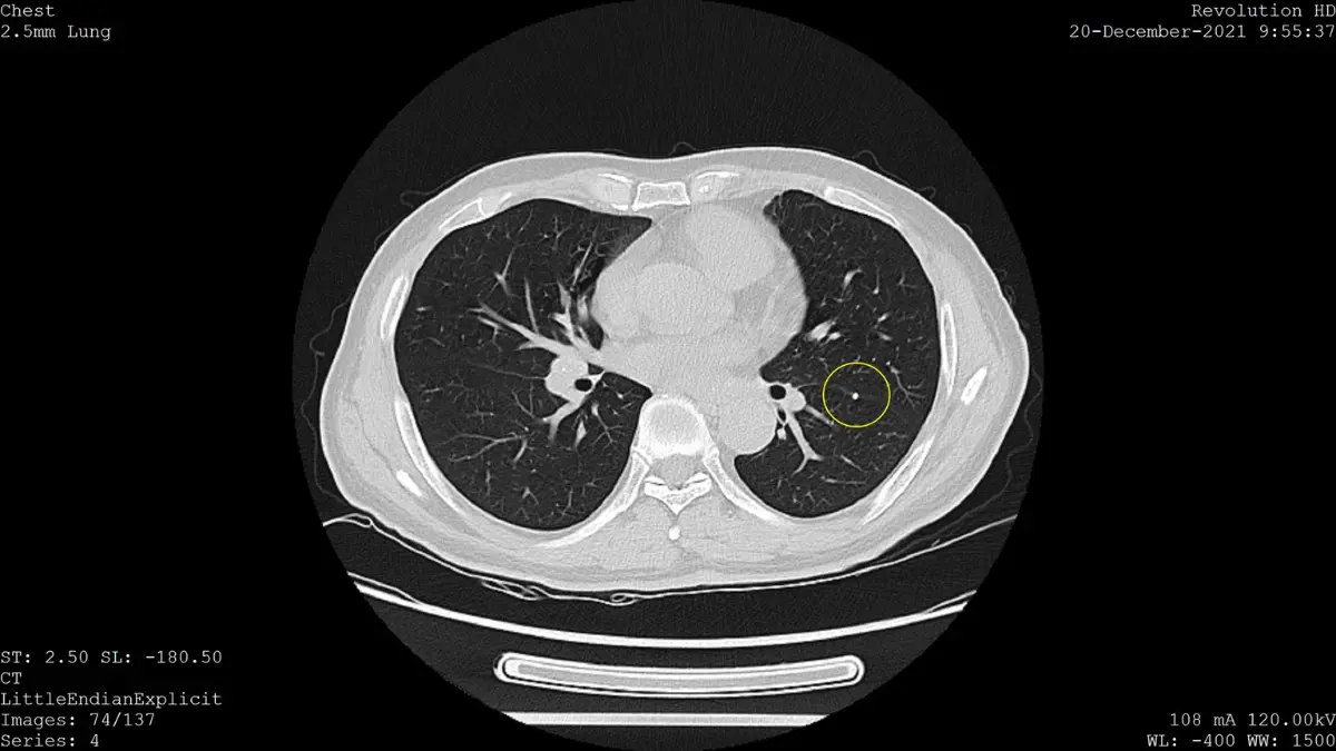 Diagram of lung alveoli and capillary structure showing the microscopic tissue examined during a lung cancer CT scan for ground-glass opacity and consolidation findings