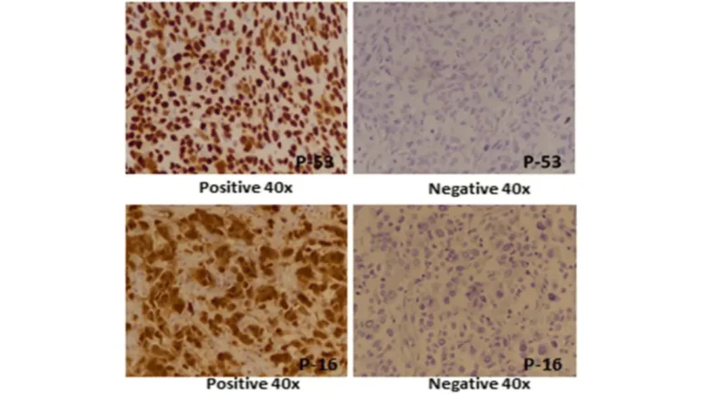 triple-negative breast cancer biomarker pathology showing p53 and p16 immunohistochemical expression patterns