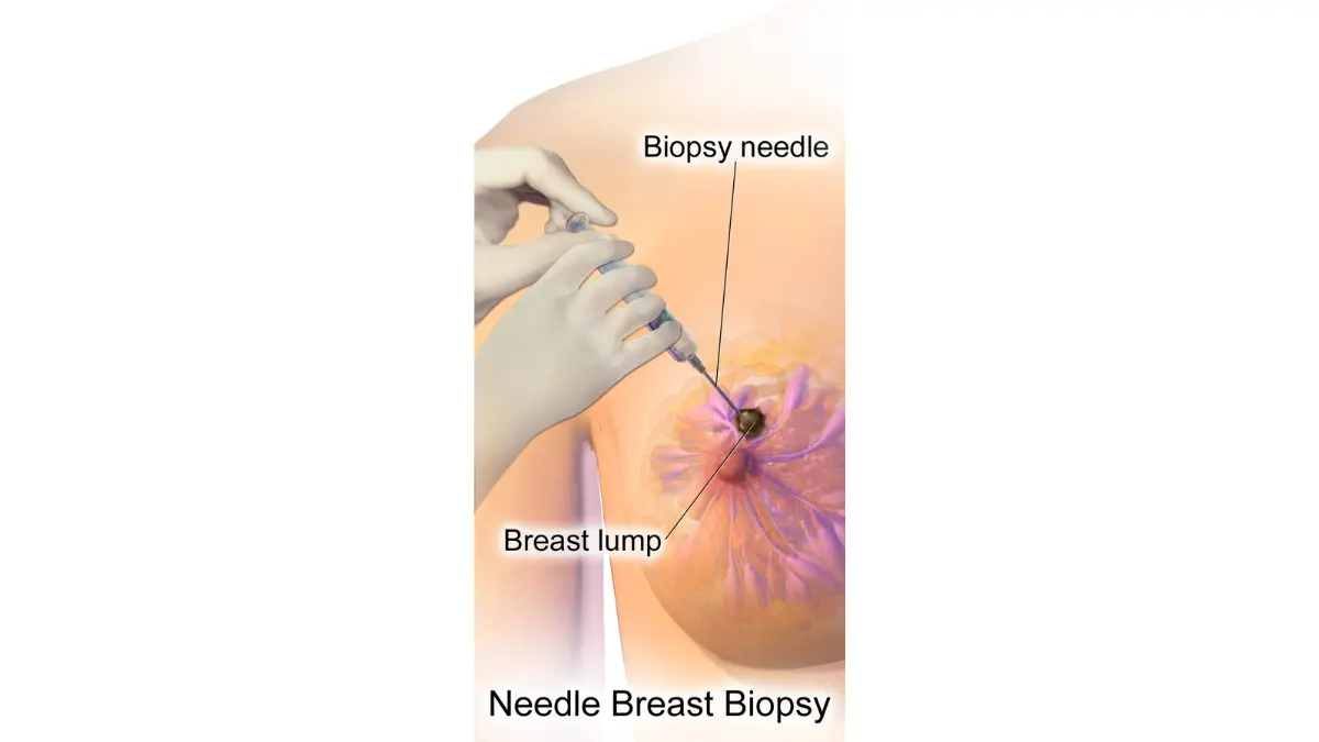 triple-negative breast cancer core needle biopsy procedure illustration for tumor tissue diagnosis