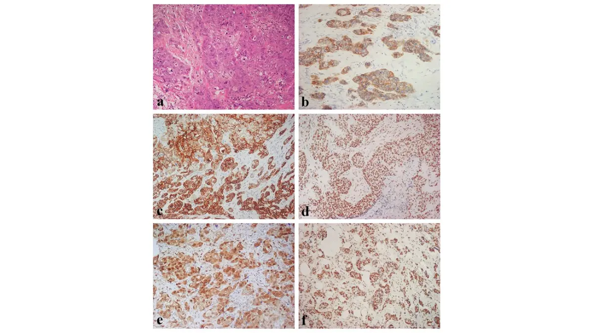 triple-negative breast cancer immunohistochemistry pathology showing receptor-negative tumor staining patterns