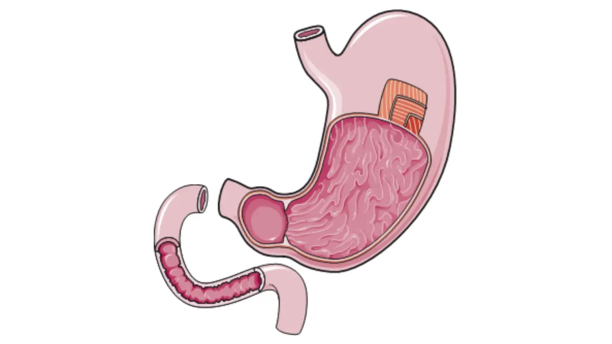 bowel obstruction treatment illustration showing stomach and duodenum anatomy before stent or bypass procedures
