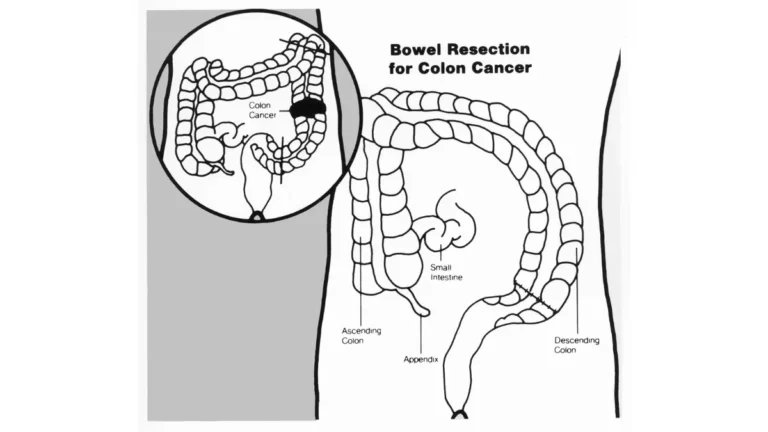 Colon Cancer in Young Adults – medical illustration showing bowel resection surgery for colorectal cancer treatment