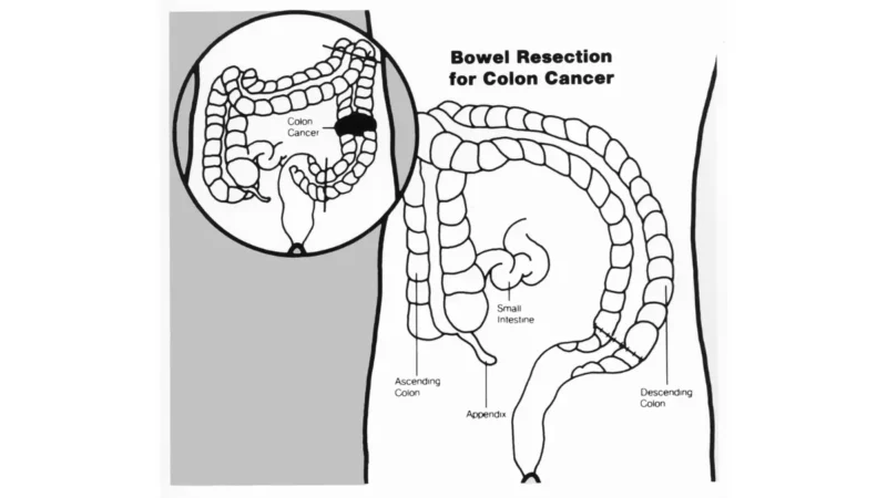 Colon Cancer in Young Adults – medical illustration showing bowel resection surgery for colorectal cancer treatment