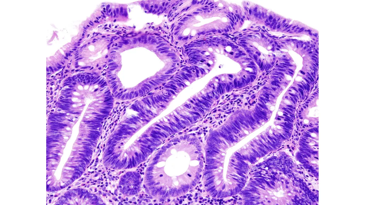 Colon Polyps adenoma specimen removed during polypectomy