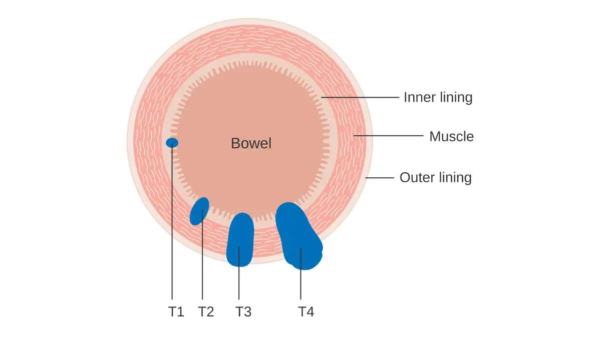 Colon Polyps high-risk progression and bowel cancer staging diagram