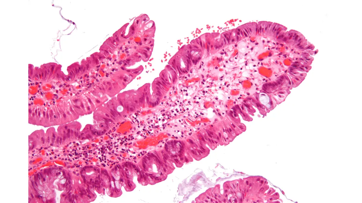 Colon Polyps traditional serrated adenoma histology image