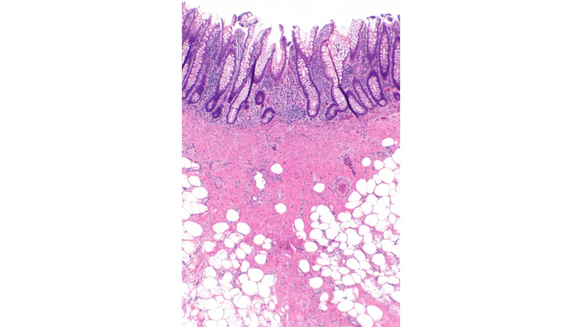 Colonoscopy complications image showing a colorectal polypectomy scar related to post-procedure bleeding risk