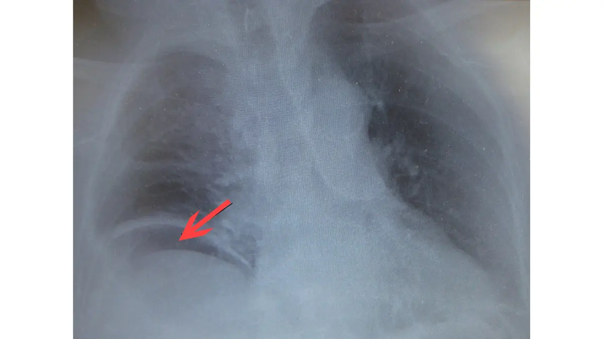 Colonoscopy complications radiology image showing double wall sign associated with bowel perforation