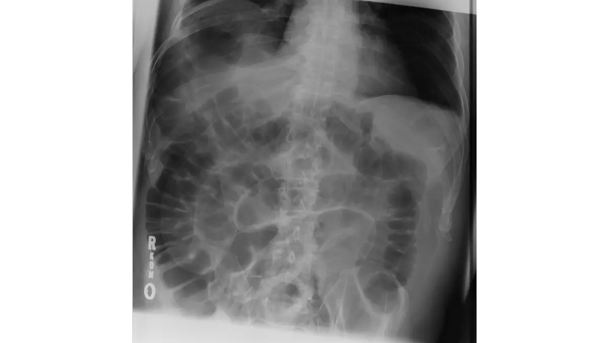 Colonoscopy complications X-ray showing free air from bowel perforation after colonoscopy