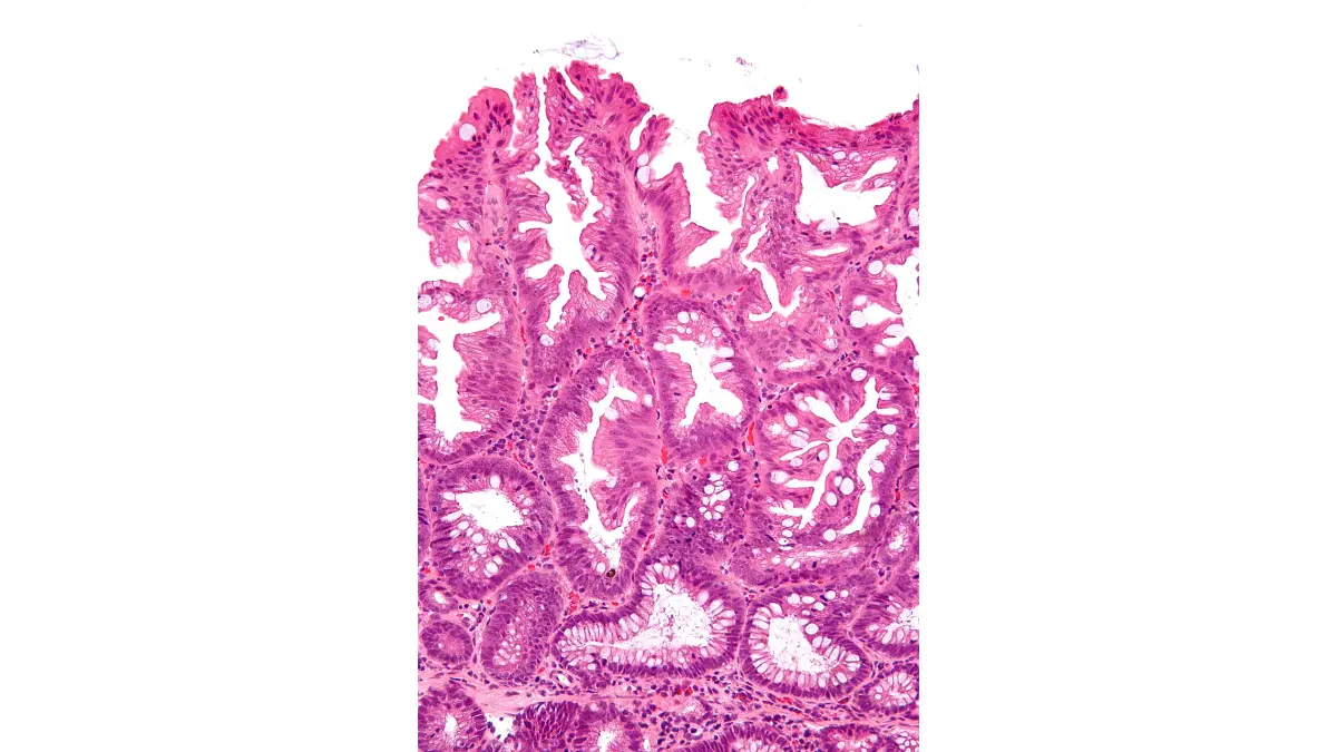 Colonoscopy pathology report histology image showing a sessile serrated adenoma at high magnification.