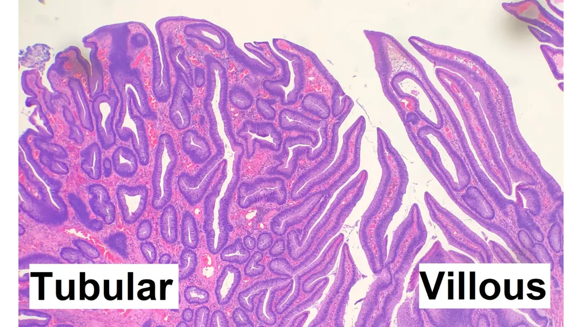 Colonoscopy pathology report histology image showing a tubulovillous adenoma under the microscope.