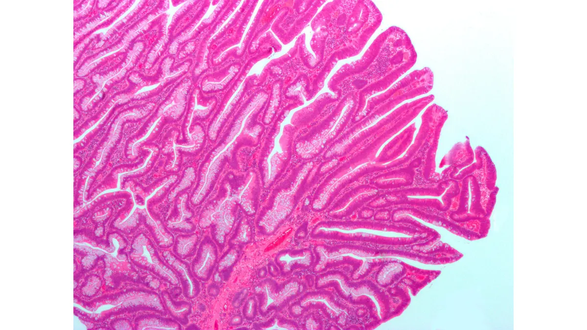 Colonoscopy pathology report micrograph showing a villous adenoma associated with higher-risk follow-up findings.