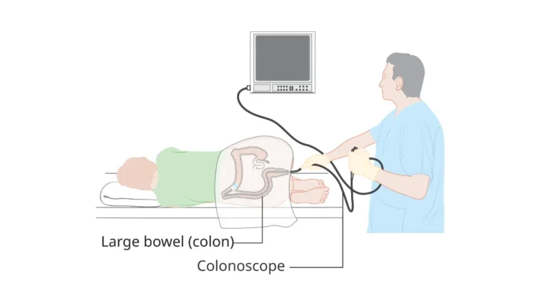 colonoscopy procedure diagram showing scope path through the colon