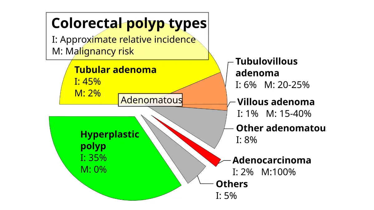 colonoscopy result colorectal polyp etiologies illustration