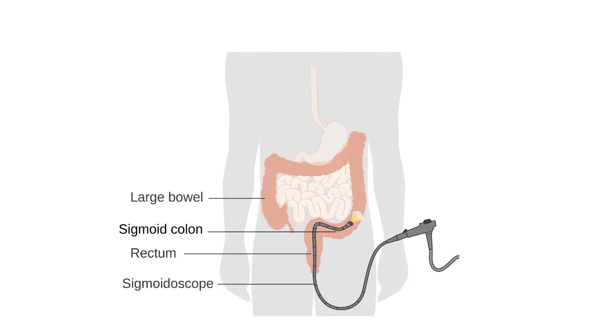 Medical diagram showing colonoscopy sedation levels with sigmoidoscopy scope insertion path through the lower GI tract.