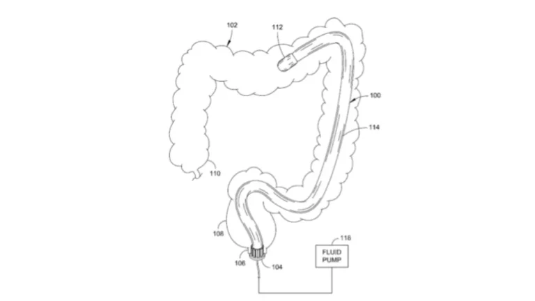 Robotic colonoscopy system used during colonoscopy sedation to guide the endoscope through the large intestine.