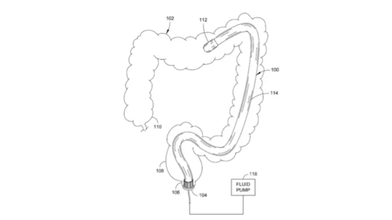 Robotic colonoscopy system used during colonoscopy sedation to guide the endoscope through the large intestine.