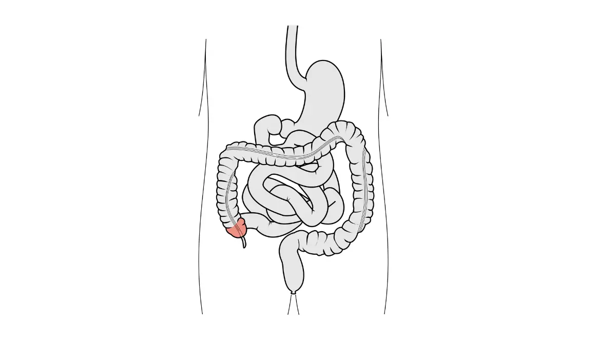 Medical illustration of colorectal cancer in the large intestine for Colonoscopy After 75 decision-making context.