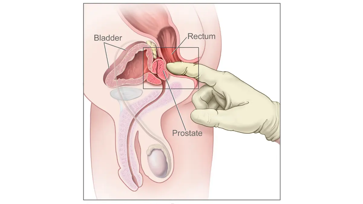 Cross-sectional anatomical diagram of a digital rectal exam showing the prostate, bladder, and rectum, a clinical step in evaluating a high PSA result