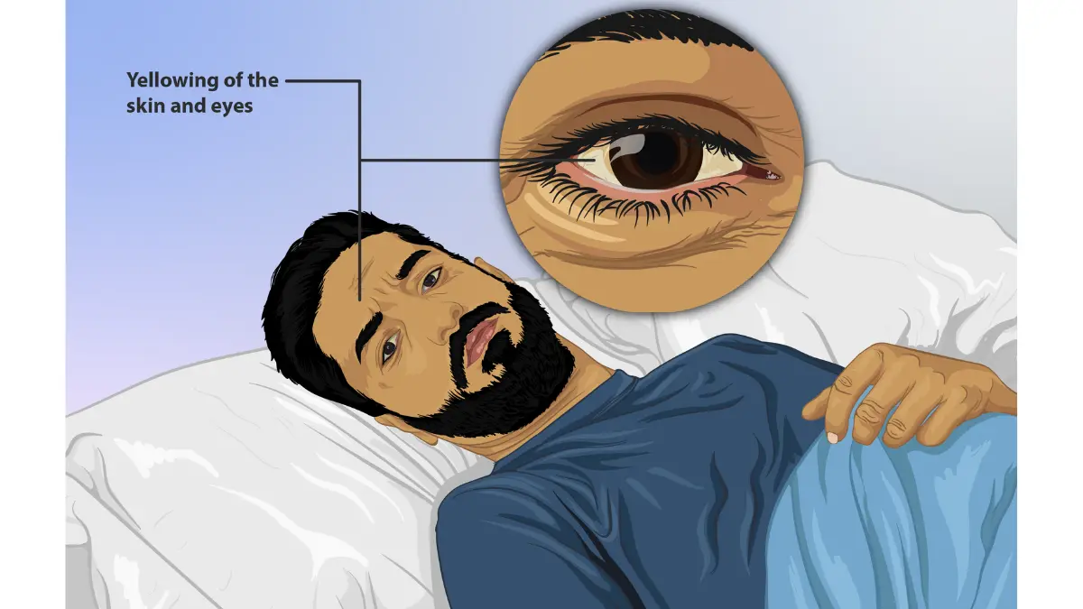 Early Signs of Pancreatic Cancer symptom illustration showing jaundice with yellowing of the eyes and skin.