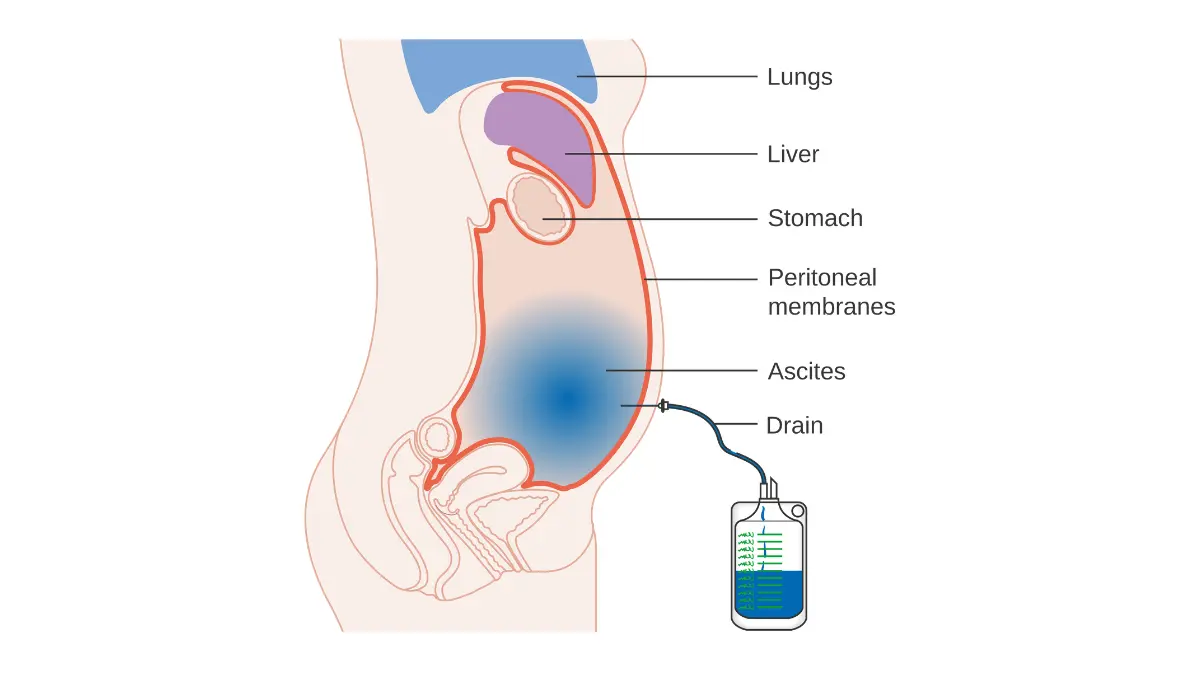 End-Stage Pancreatic Cancer diagram showing ascites fluid buildup in the abdomen being drained for comfort through paracentesis.