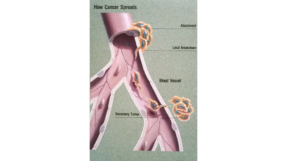End-Stage Pancreatic Cancer illustration showing how cancer cells break away from a primary tumor and metastasize to distant organs such as the liver and lungs.
