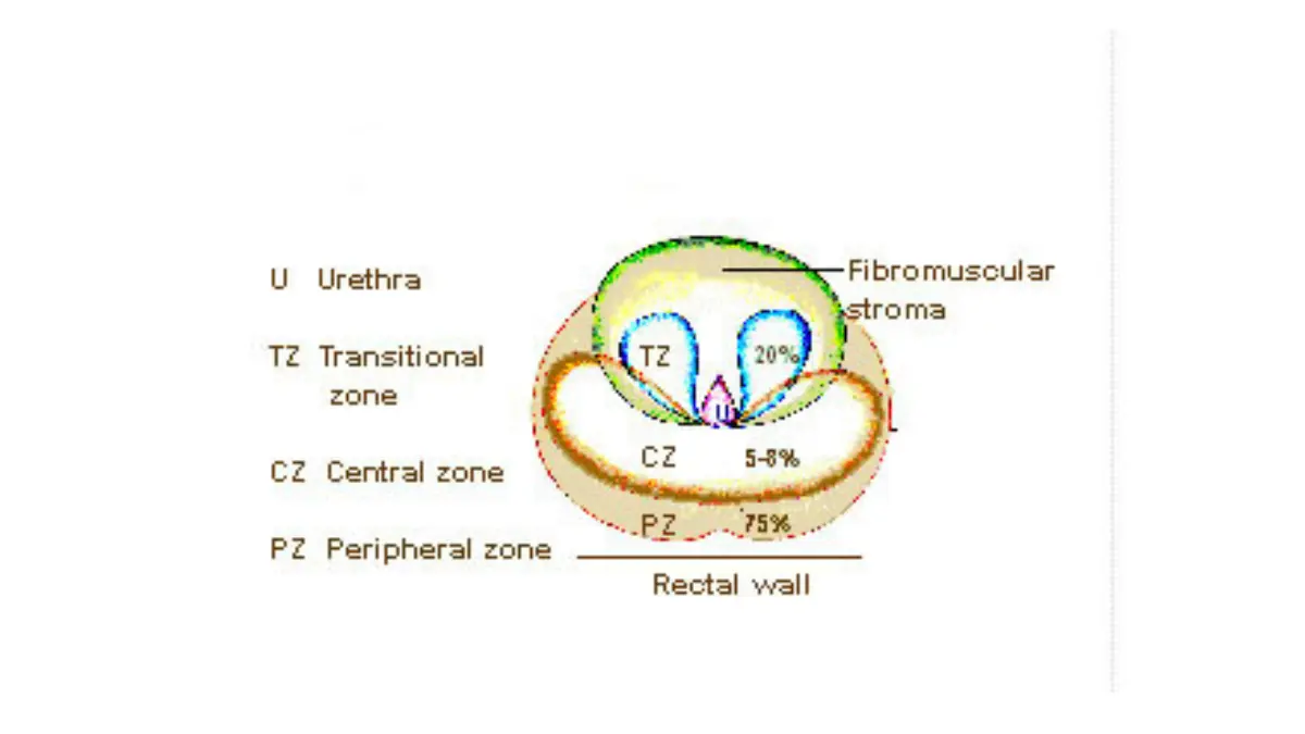 Prostate zones diagram highlighting where Enlarged Prostate tissue (BPH) grows around the urethra versus where cancer often starts in the peripheral zone.
