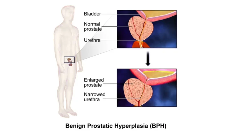 Enlarged Prostate illustration comparing normal and enlarged prostate (benign prostatic hyperplasia) compressing the urethra.