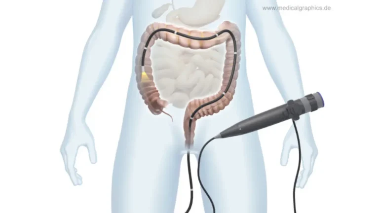 Family History of Colon Cancer - Transparent human figure undergoing colonoscopy procedure showing colon anatomy and screening process