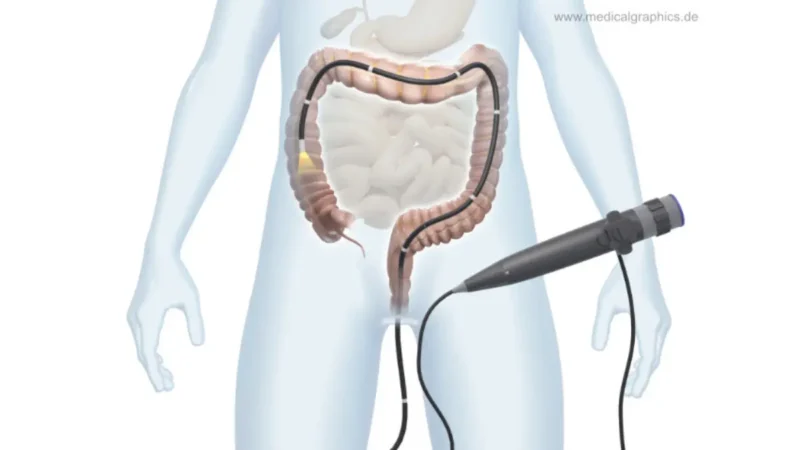 Family History of Colon Cancer - Transparent human figure undergoing colonoscopy procedure showing colon anatomy and screening process
