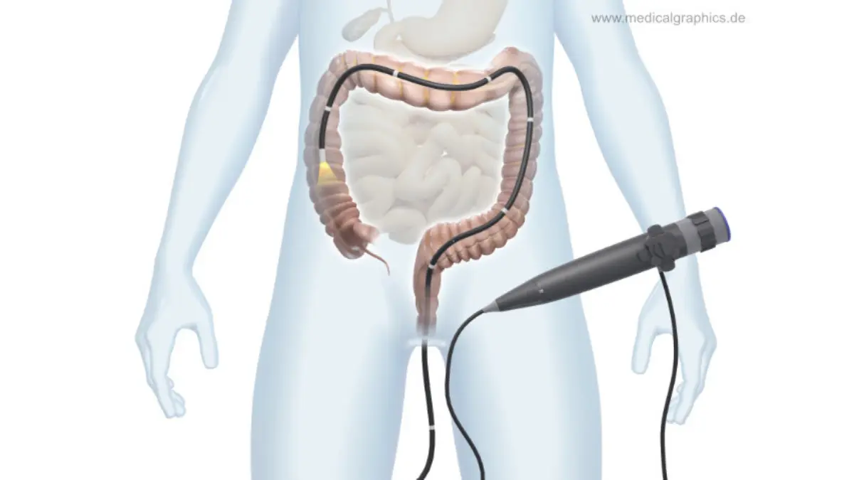Family History of Colon Cancer - Transparent human figure undergoing colonoscopy procedure showing colon anatomy and screening process