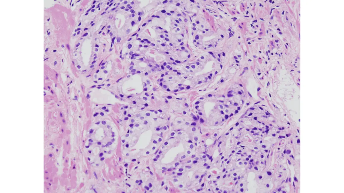 Gleason score acinar adenocarcinoma histology from core needle biopsy specimen