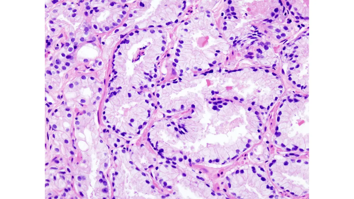 Gleason score prostate cancer histopathology micrograph for biopsy accuracy comparison