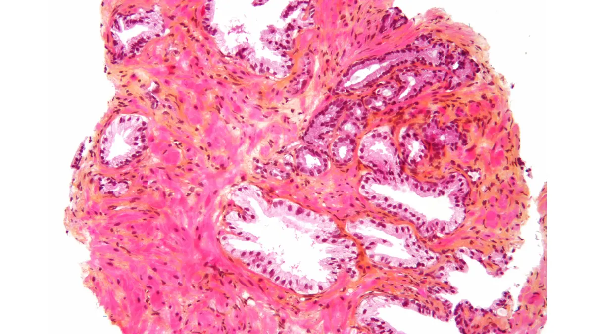 Gleason score needle biopsy micrograph showing prostate adenocarcinoma cells at high magnification