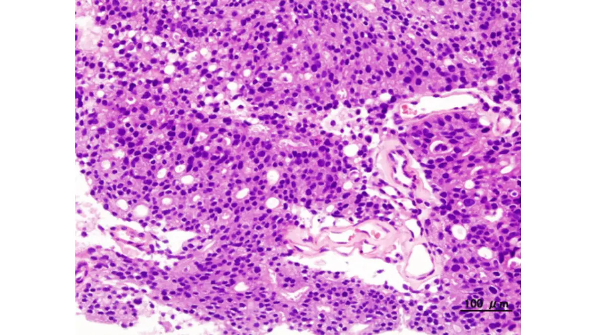 Gleason score pattern 4 histopathology image showing prostate adenocarcinoma microscopic view