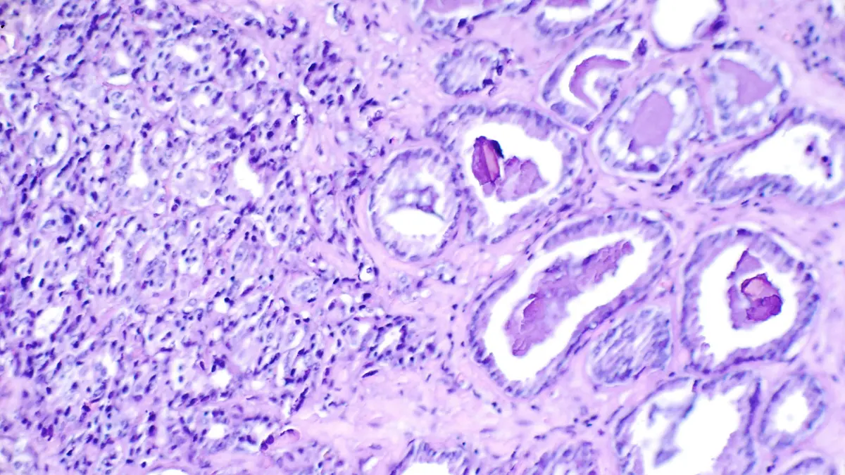 Gleason score histology reference showing prostate cancer cellular patterns under microscope