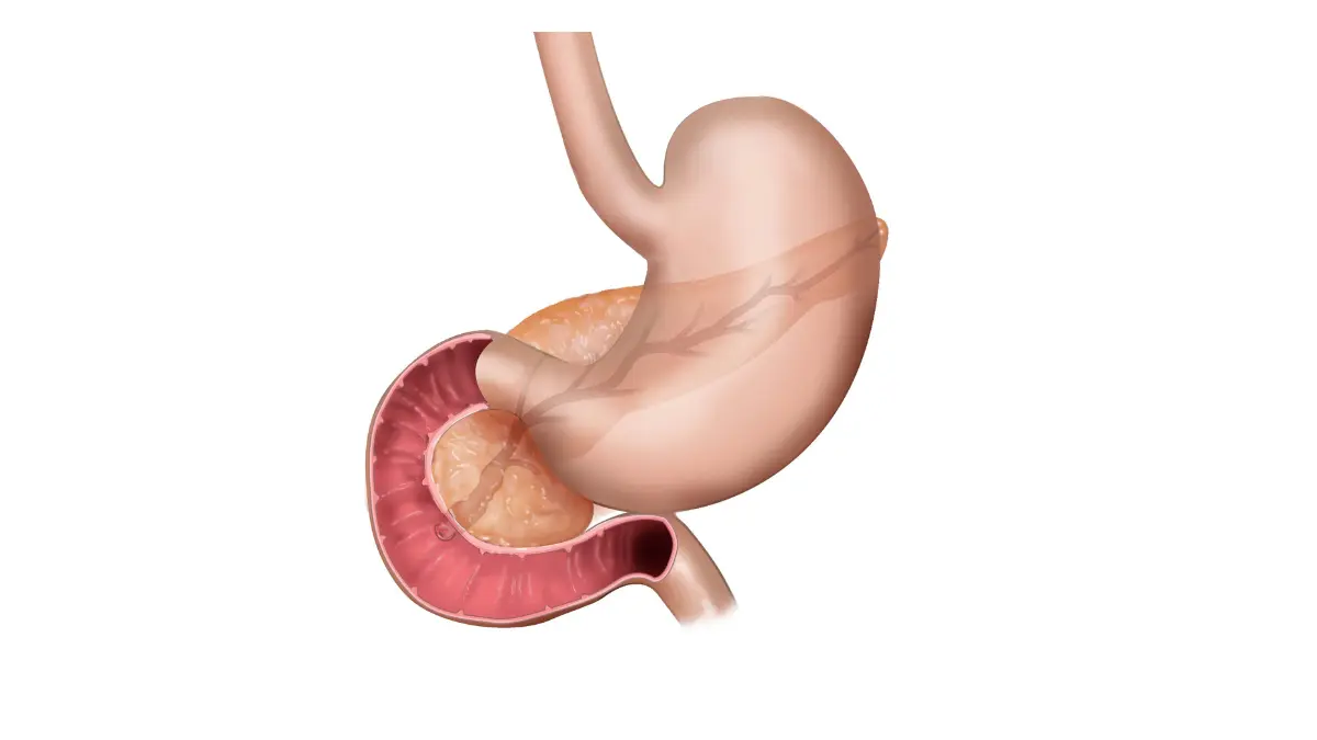 Hereditary pancreatic cancer anatomy illustration showing the stomach, duodenum, and pancreas for screening context.
