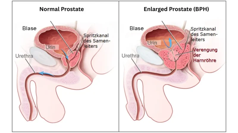 Medical illustration comparing normal and enlarged prostate anatomy, showing why benign prostatic hyperplasia is a frequent non-cancer cause of a high PSA result