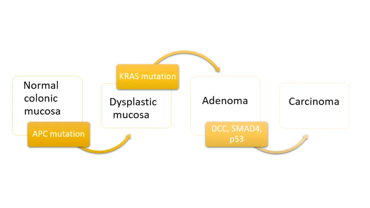 How Often Need Colonoscopy adenoma to carcinoma pathway illustration showing how a colon polyp can progress over time.